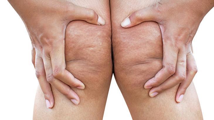 Lipödem kadınların sessiz çığlığı! ‘Neden kilo veremiyorum’ diyenler için cevap